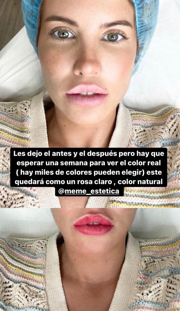 Cote López muestra resultados de procedimiento en sus labios
