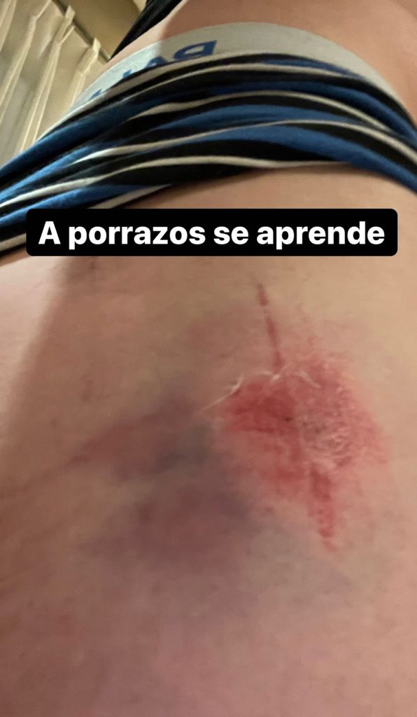 “A porrazos”: Gonzalo Valenzuela muestra fea lesión