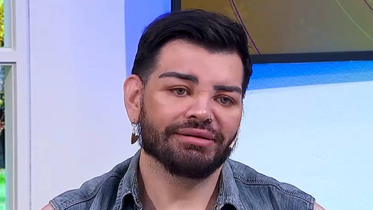 No salió como esperaba: Hombre pasó por 30 cirugías para parecerse a Ricky Martin 