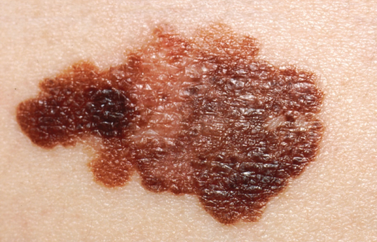 Vacuna contra melanoma