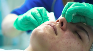 Ácido glicólico y peeling: Dermatóloga explicó cómo combatir el acné