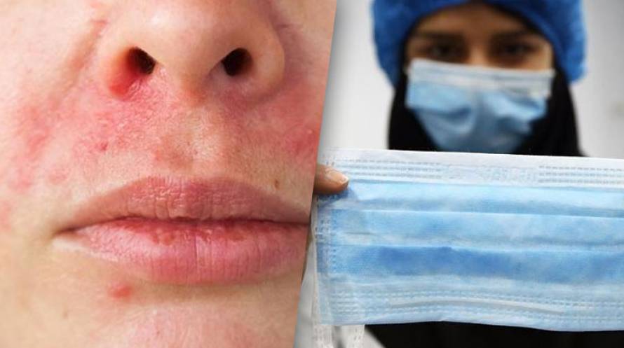 Acné y dermatitis por uso de la mascarilla ¿Qué hacer?
